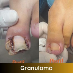 Tratamento de Granuloma Perfil Feet